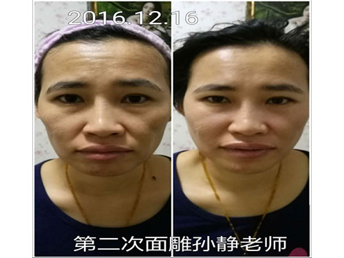 孙静老师调理的面部精雕