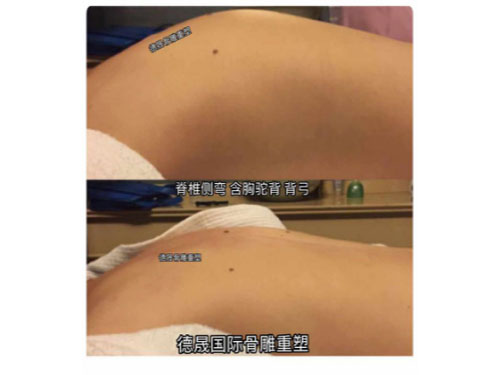 孙总调理的强直性脊柱炎