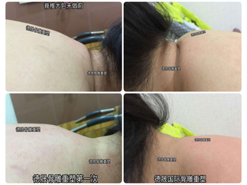 德晟百年老师调理的颈椎大包