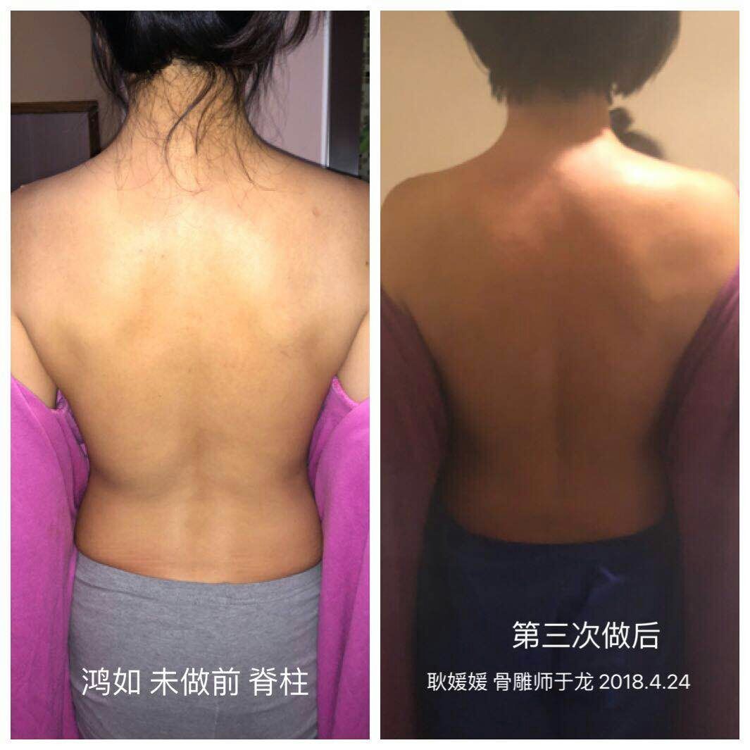 于总调理鸿如脊柱侧弯顾客